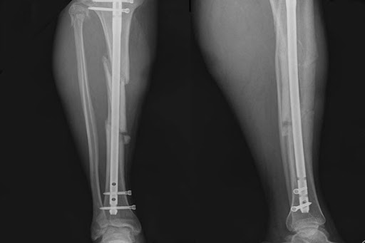 Diagnosis of Delayed Union and Non-Union